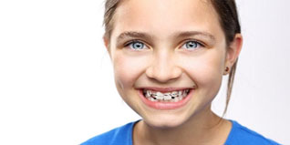 What To Expect When Getting Braces